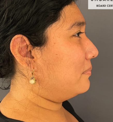 Submental Liposuction Before, Female 46 - 3862