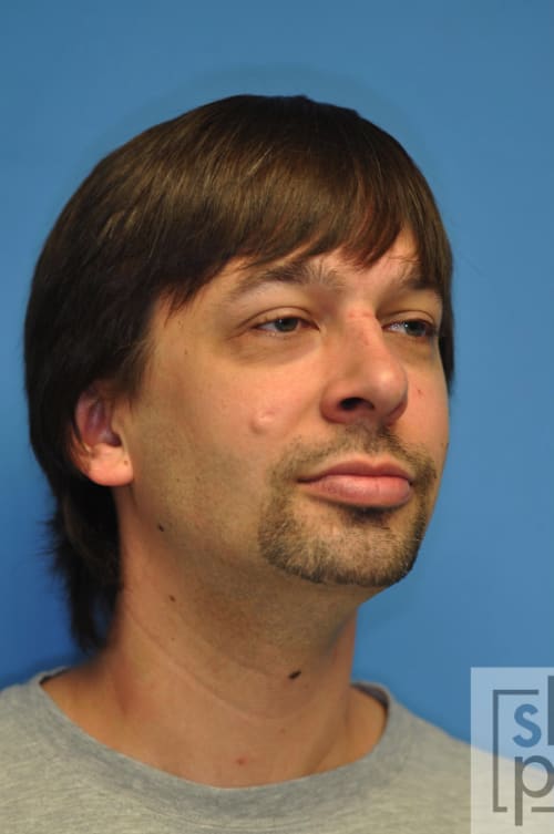 Birthmark, Mole, & Skin Growth Removal Solutions Before, Female 31 - 3866