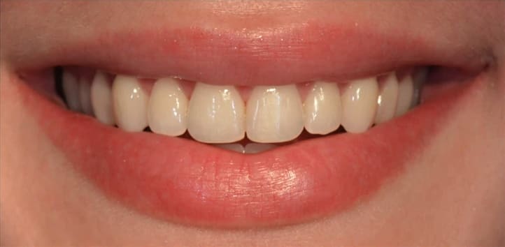 Invisalign® After, Female 28 - 3900
