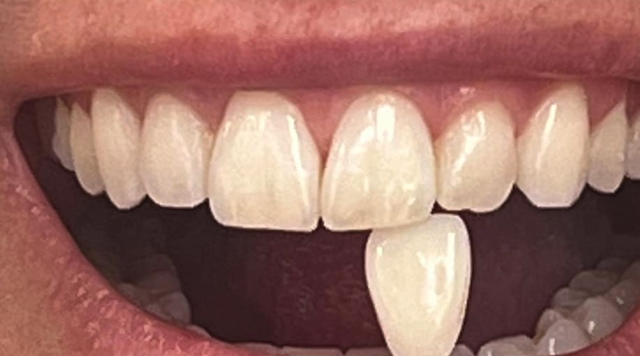 Teeth Whitening Before, Female 30 - 3980