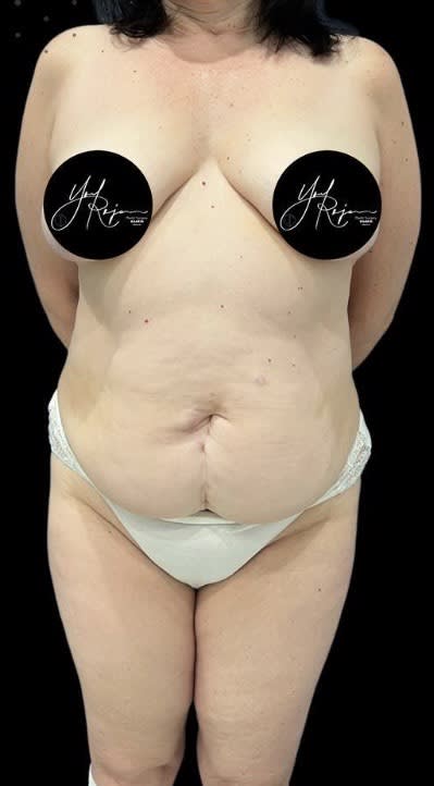 Abdominoplasty Before, Female 61 - 4017