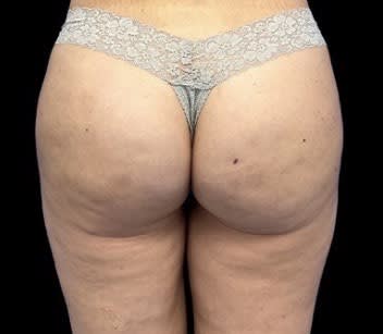 Cellulite Removal Before, Female 43 - 4018