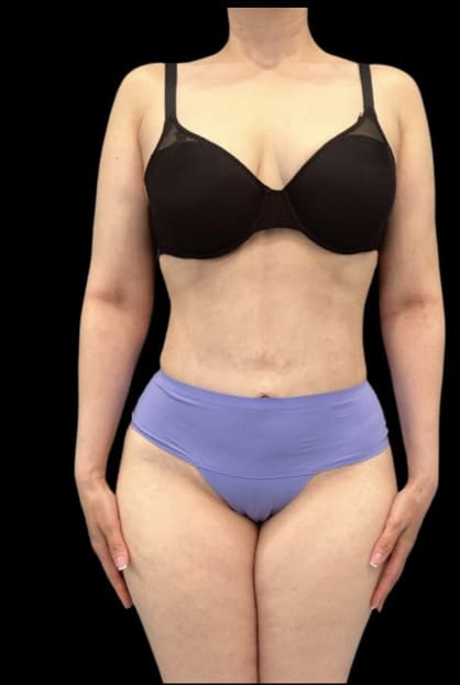 Liposuction After, Female 41 - 4019