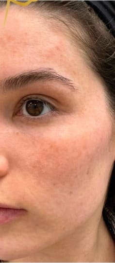 Chemical Peels Before, Female 27 - 4030