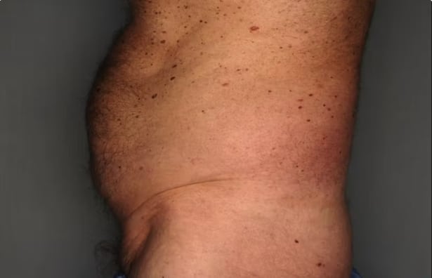 CoolSculpting® Before, Male 46 - 4038