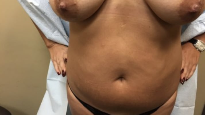 Liposuction Before, Female 56 - 4050