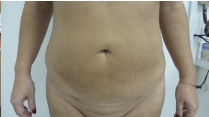 Liposuction After, Female 56 - 4050
