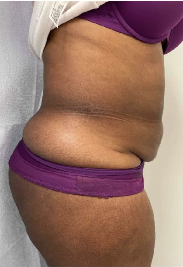 Tummy Tuck (Abdominoplasty) Before, Female 34 - 4067