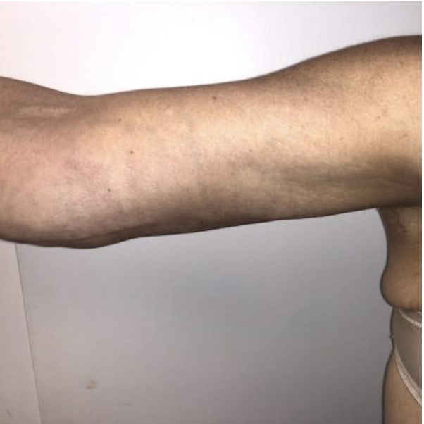 Arm Lift After, Female 62 - 4073