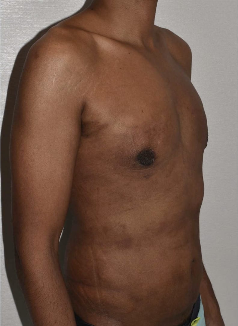 Male Breast Reduction (Gynecomastia Surgery) After, Male 32 - 4110