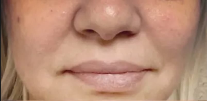 Dermal Filler & Injectable Solutions Before, Female 40 - 4121
