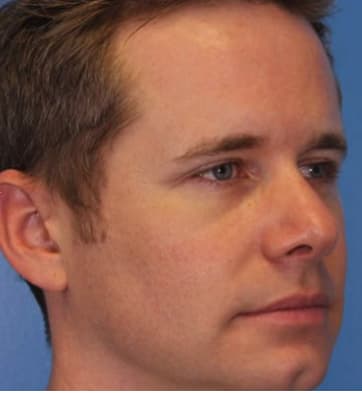 Botox After, Male 37 - 4144