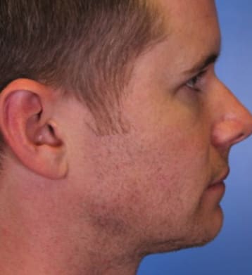 Neck & Jawline Definition Solutions After, Male 37 - 4149