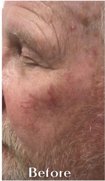 Vein Treatment Before, Male 60 - 4245