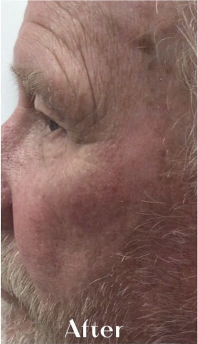 Vein Treatment After, Male 60 - 4245
