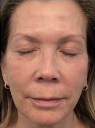 Cheek Augmentation with Fillers After, Female 58 - 4247