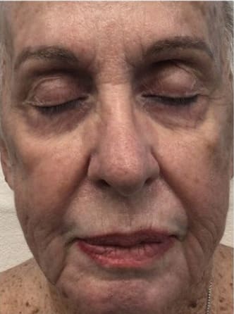 Juvéderm® Before, Female 61 - 4252