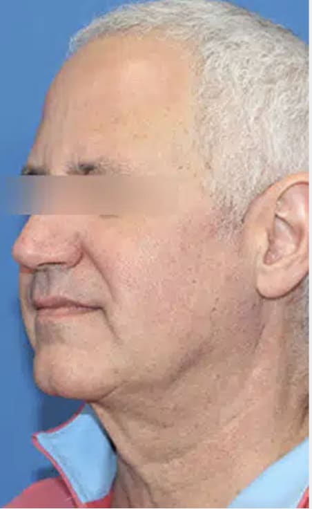 Facelift Before, Male 56 - 4324