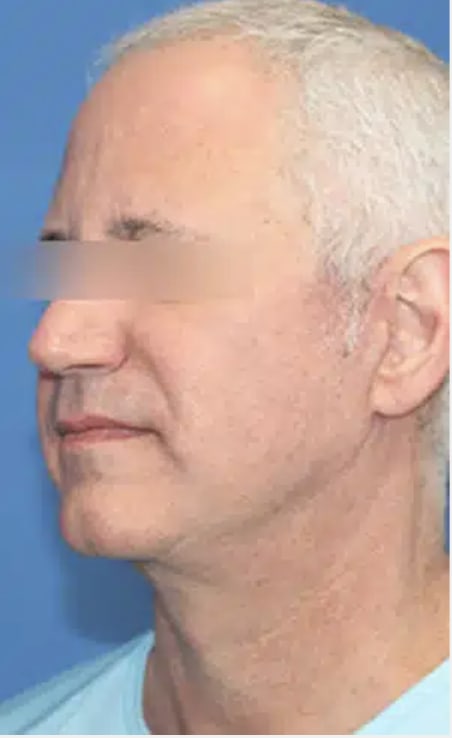 Facelift After, Male 56 - 4324