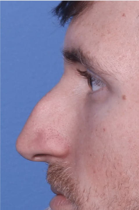 Rhinoplasty Before, Male 34 - 4337