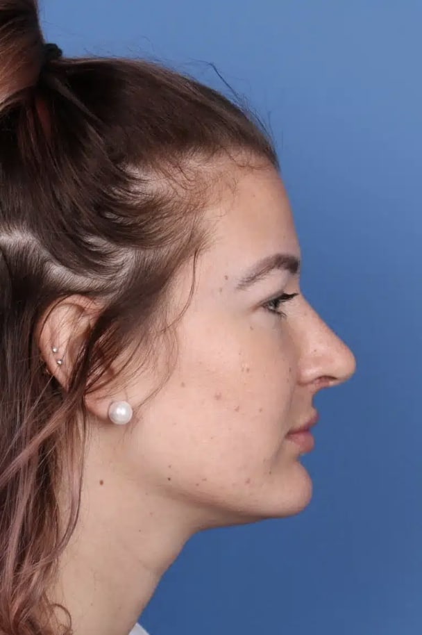 Rhinoplasty After, Female 30 - 4342