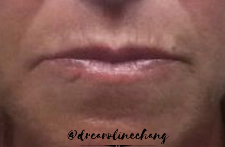 Dermal Fillers & Injectables Before, Female 50 - 4364