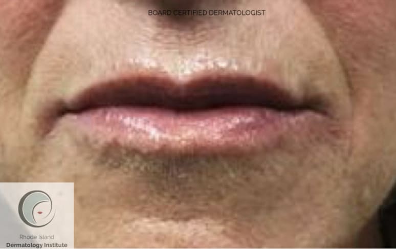 Dermal Fillers & Injectables After, Female 50 - 4364