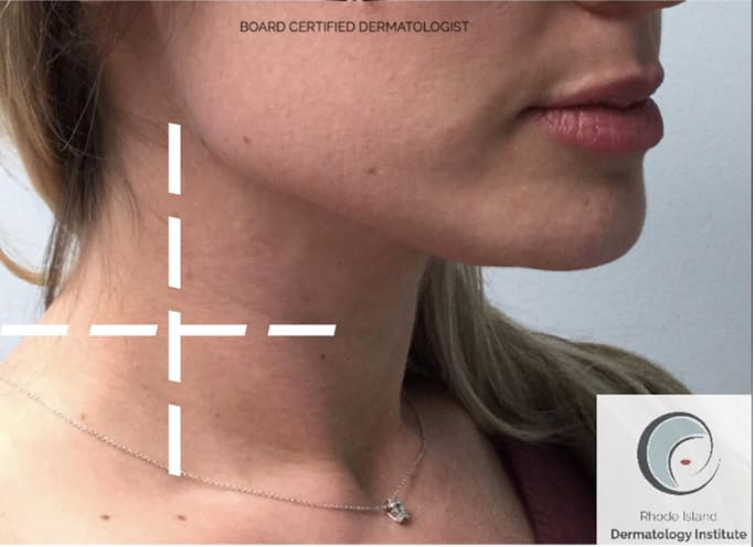 PDO Thread Lift After, Female 36 - 4365