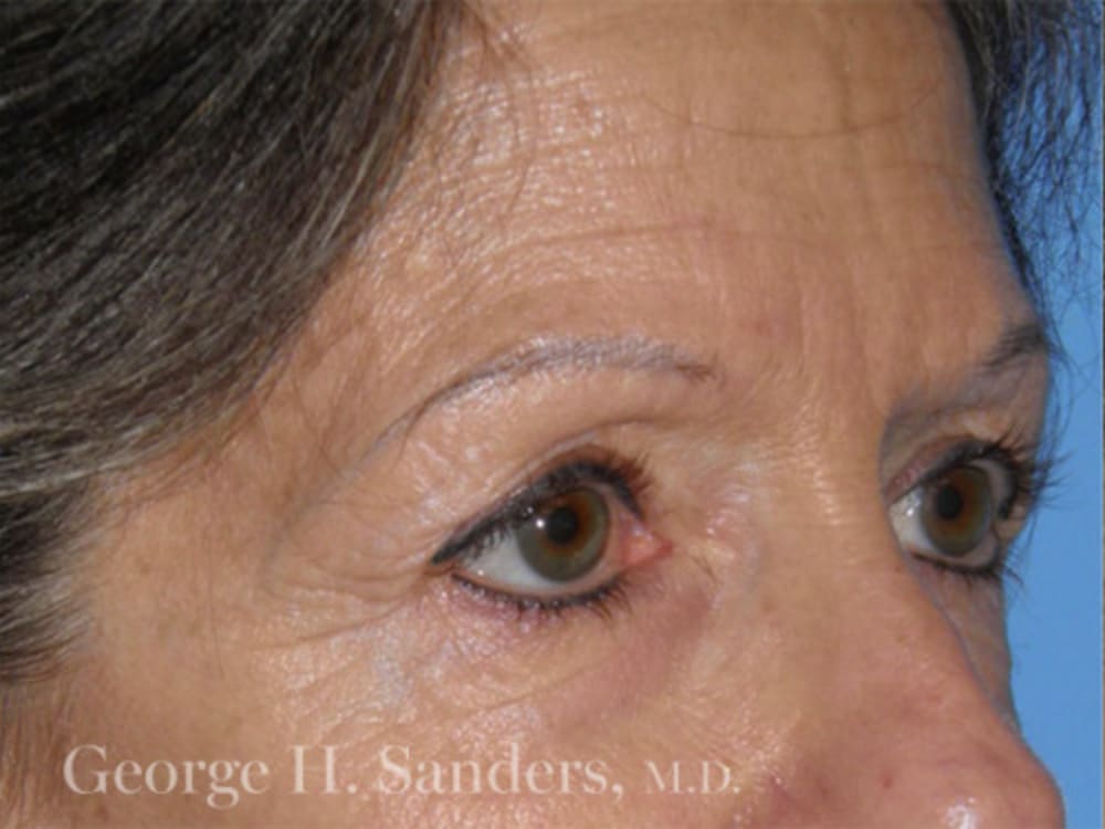 Brow Lift Before, Female 59 - 4379