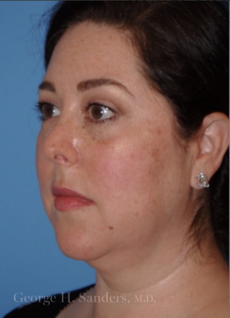 Liposuction Before, Female 40 - 4382