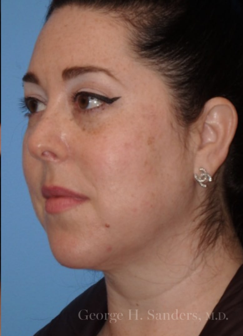 Liposuction After, Female 40 - 4382