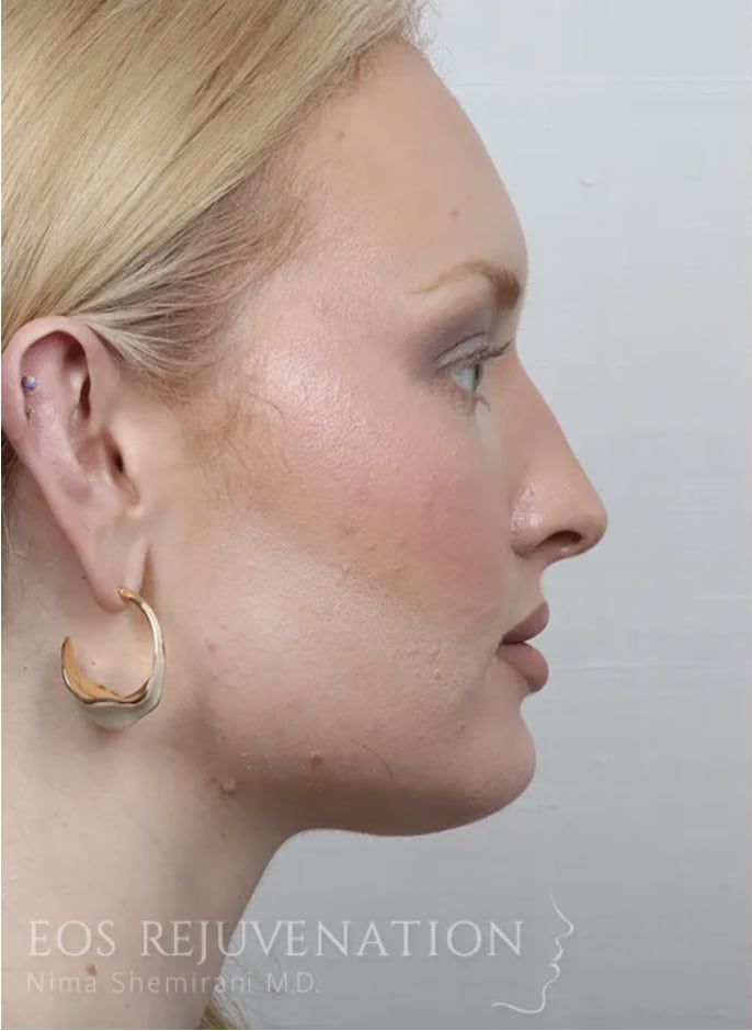 Rhinoplasty Before, Female 33 - 4399