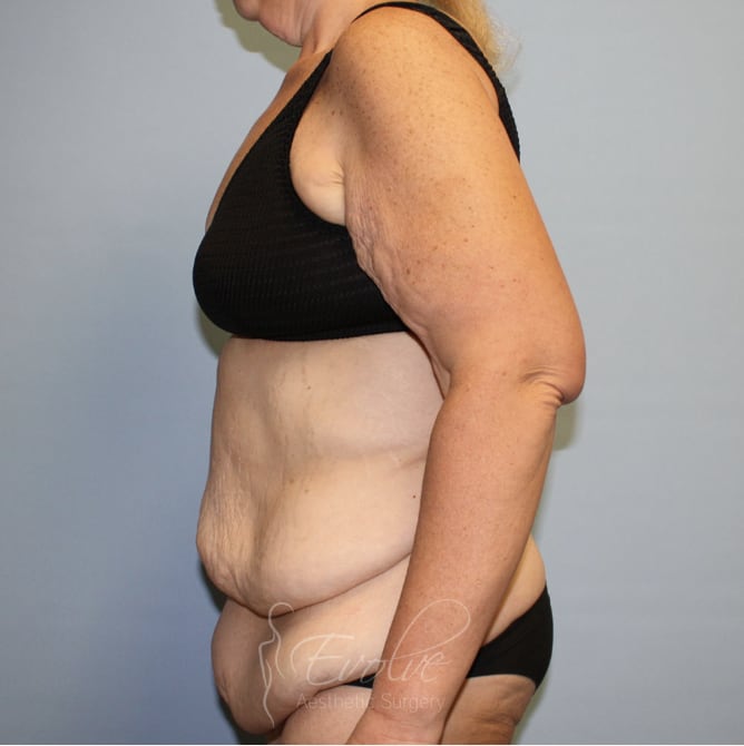 Tummy Tuck (Abdominoplasty) Before, Female 59 - 4486