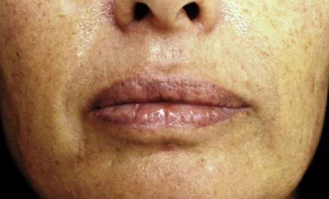 Sculptra® After, Female 48 - 2032