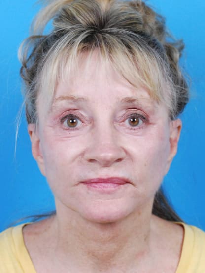 Eyelid Correction Solutions After, Female 56 - 2364