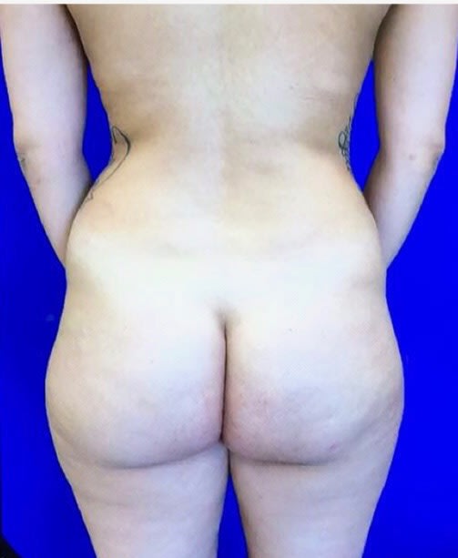 Brazilian Butt Lift Before, Female 31 - 1763