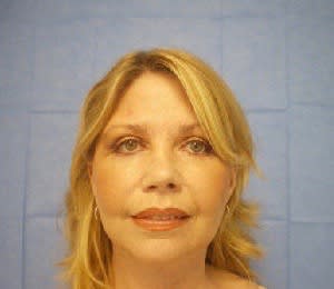 Facelift After, Female 52 - 1755