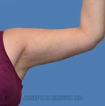 Arm Lift (Brachioplasty) After, Female 34 - 2068