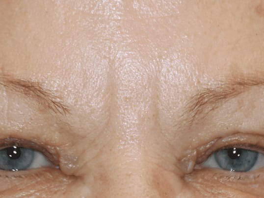 Skin Smoothing Solutions After, Female 64 - 2828