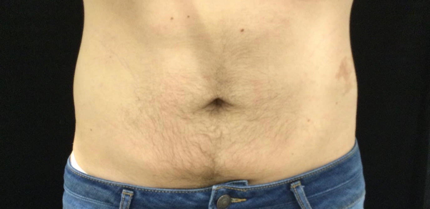 Abdominal Slimming Solutions After, Male 34 - 1830