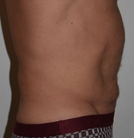 Abdominoplasty Before, Male 59 - 267