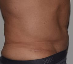 Abdominoplasty After, Male 59 - 267