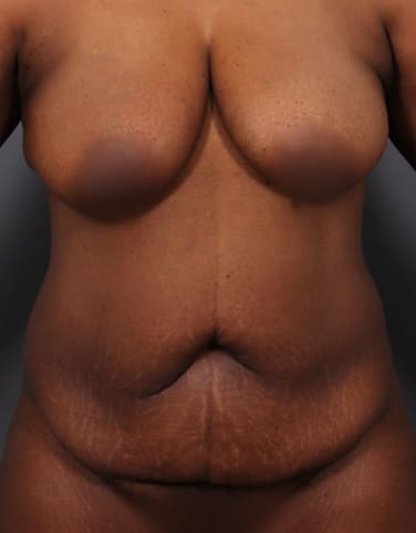 Abdominoplasty Before, Female 41 - 4571