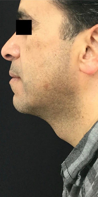 Facial Skin Firming & Lifting Solutions After, Male 46 - 2425