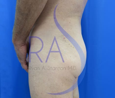 Butt Augmentation with Implants Before, Male 58 - 436