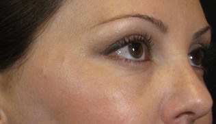 Plasma Skin Resurfacing Before, Female 41 - 2742