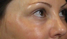 Plasma Skin Resurfacing After, Female 41 - 2742