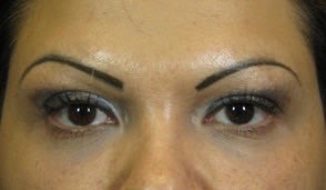 Plasma Skin Resurfacing After, Female 44 - 2741