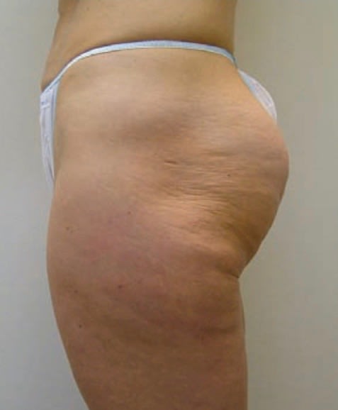 VelaShape® Before, Female 36 - 1859