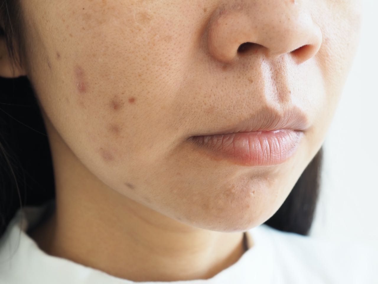 Gør alt med min kraft Flåde Tilbageholdenhed How To Treat Post-Inflammatory Hyperpigmentation Caused By Acne | The  AEDITION